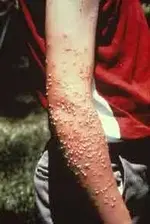 antstings.webp
