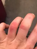 irridium burn .webp