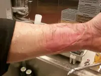 arm burn 1.webp