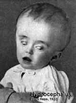 hydrocephalus.webp