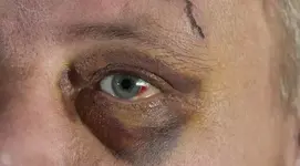blaues-Auge-672x372.webp