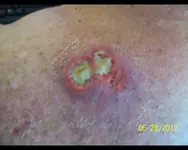 Spider bite1.webp Spider bite1.webp