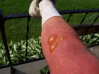 blisters.webp