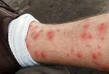 280_190_photo_of_chigger_bites_on_leg.webp