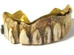 Dentures-front-150x113.jpg