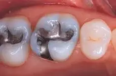 Silver Fillings.webp