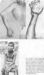 Puff adder bite.webp