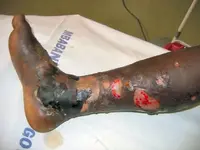Puff adder bite3.webp