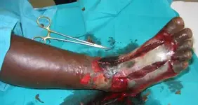 Puff adder bite4.webp