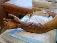 Rattlesnake Bite.webp