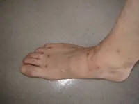 Bug Bites.webp