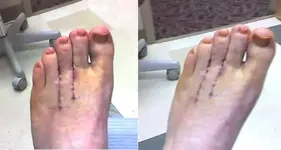 foot 1 - Copy.webp