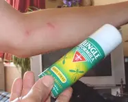 Horse-Fly-Bites.webp