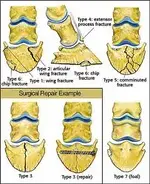 coffin bone.webp