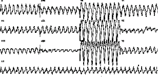 ekg01-96.gif