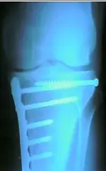 Leg2 (398x640).webp
