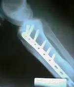 Leg1 (542x632).webp