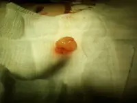 tumor2.webp