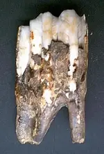 tooth5.webp