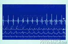 ekg-of-abnormal-heart-beat-7-316-~-312335.jpg