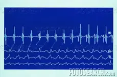 ekg-of-abnormal-heart-beat-7-316-~-312335.webp