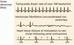 EKG photo.gif