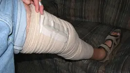 Left knee.webp