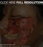 flesh-eating-bacteria-pictures.webp